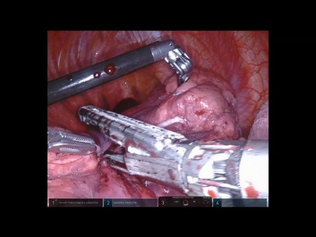 Robotic Posterior Segmentectomy of the Right Upper Lung Lob