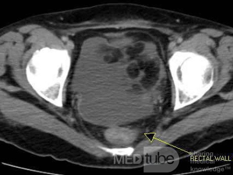 Multiple Rectal Ulcers (45 of 110)