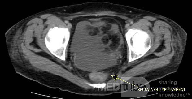 Multiple Rectal Ulcers (45 of 110)