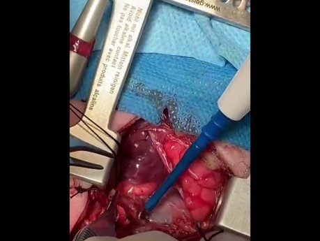 Tracheal Stenosis Extensive Resection in Pediatric 