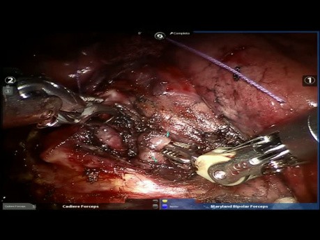Lung Cancer - Neoadjuvant Treatment (Robotic Surgery)
