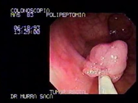 Video Colonoscopic view of a Polypectomy