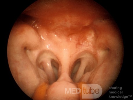 Carcinoma of the Nasopharynx