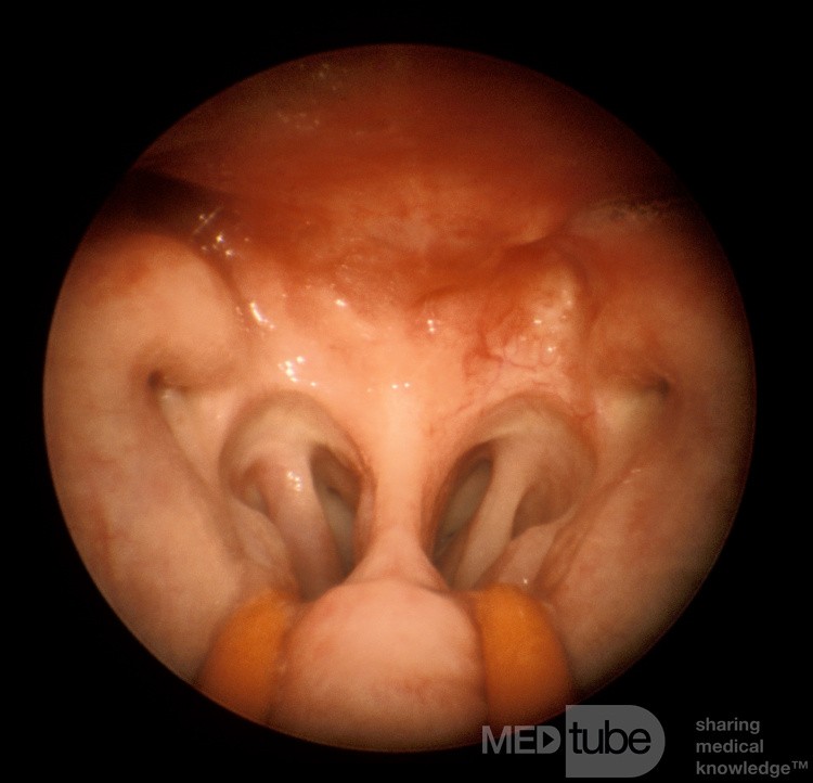Carcinoma of the Nasopharynx