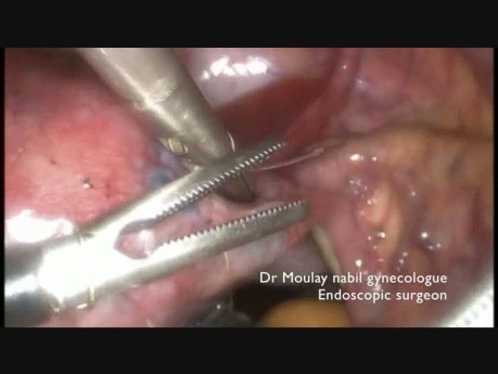 Laparoscopic Salpingoplasty for Tubal Infertility