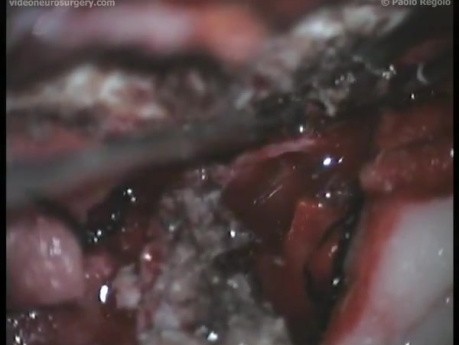 Olfactory Grooves Meningioma - Bifrontal Approach