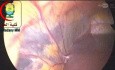Colonic Distension and Intra-abdominal Adhesions Encountered During Laparoscopic Cholecystectomy Should not be Overlooked