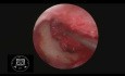 Endoscopic Myringoplasty HD