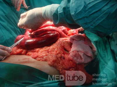 Mesenteric Ischemia (11 of 12)