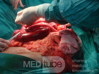 Mesenteric Ischemia (11 of 12)