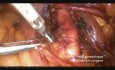 Omentectomy, Pelvic and Para Aortic Lymphadenectomy