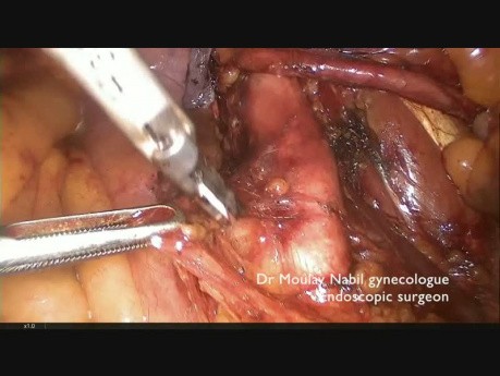 Omentectomy, Pelvic and Para Aortic Lymphadenectomy