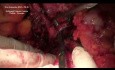 Surgery for Cardioesophageal Junction Cancer (Garlock Type)