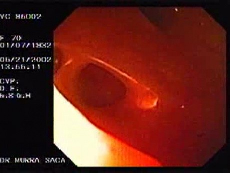 Erythematous Colon Mucosa (2 of 3)