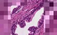 Nodular hyperplasia - Histopathology of prostate