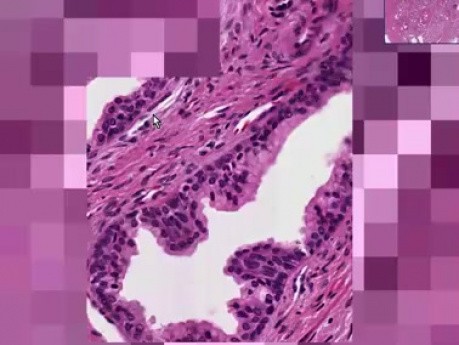 Nodular hyperplasia - Histopathology of prostate