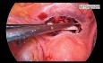 Laparoscopic Cervical Cerclage Surgery for Cervical Insufficiency