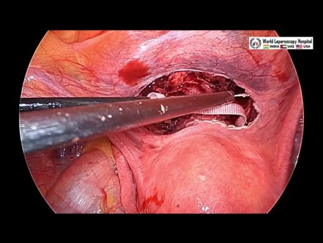 Laparoscopic Cervical Cerclage Surgery for Cervical Insufficiency