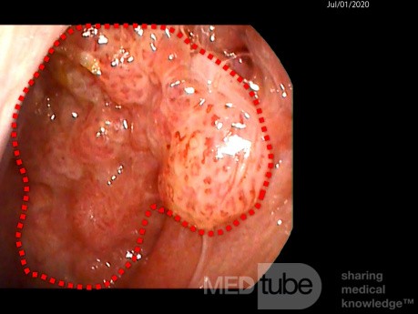 Nasopharyngeal Papillomatosis