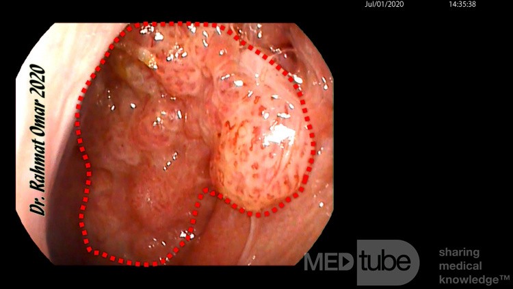 Nasopharyngeal Papillomatosis