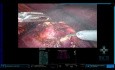 Tips and Tricks: Robotic Partial Nephrectomy with a 100% Endophytic Tumor