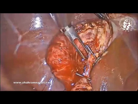 Laparoscopic Cholecystectomy in Chronic Fibrotic Cholecystitis