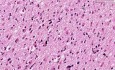 Astrocytoma - Histopathology - Brain