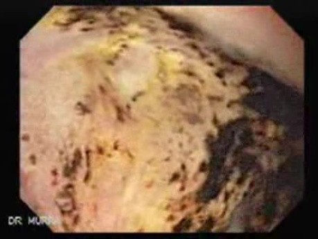 Duodenal Ulcer (4 of 5)