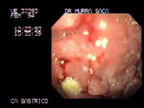 Infiltrating Gastric Carcinoma - Endoscopy