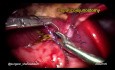 Choledochal Cyst Excision and R&Y Hepaticojejunostomy in Three Years Age Girl