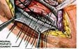 Bassini Inguinal Hernia Repair