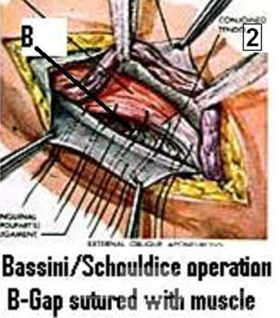 Bassini Inguinal Hernia Repair