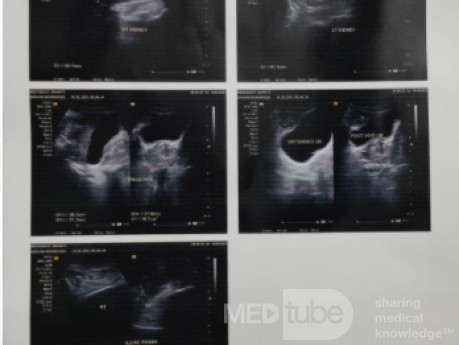 Case of Benign Prostatic Hyperplasia in a 71 Years Old Male 
