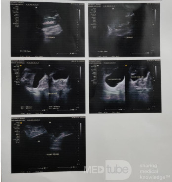 Case of Benign Prostatic Hyperplasia in a 71 Years Old Male 