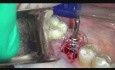 Implant Microsurgery Immediate Molar Implant