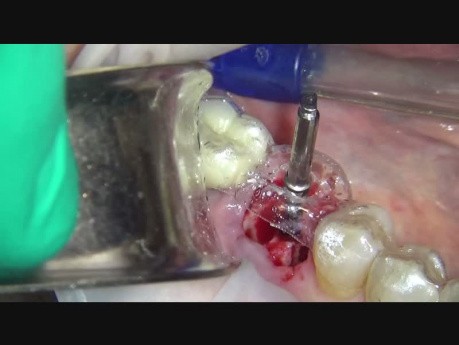 Implant Microsurgery Immediate Molar Implant