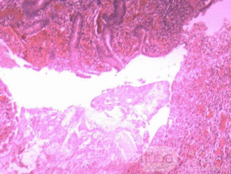 Multiple Rectal Ulcers (106 of 110)