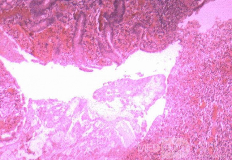 Multiple Rectal Ulcers (106 of 110)