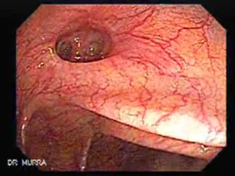Colon Diverticulum - Endoscopy (1 of 3)