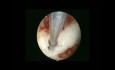 Excision Of Subseptate Uterus