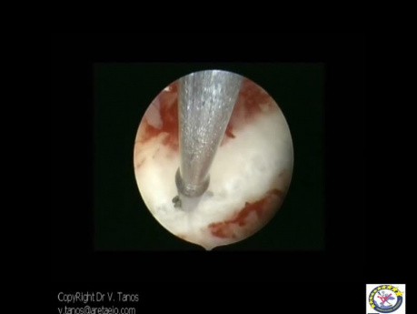 Excision Of Subseptate Uterus