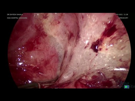 Laparoscopic Enterolysis Removal of Left Hydrosalpingx (Part 2)