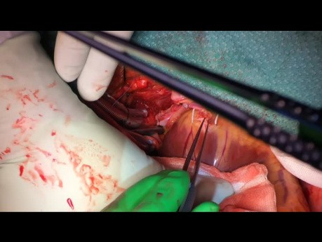 CABGx4 with Cardiopulmonary Bypass Support