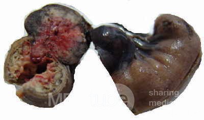 Jejunal Gastrointestinal Stromal tumor (GIST) (8 of 86)