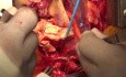 Total Aortic Arch Replacement with Stented Elephant Trunk