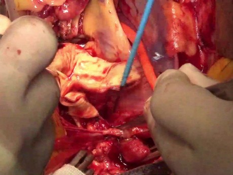 Total Aortic Arch Replacement with Stented Elephant Trunk