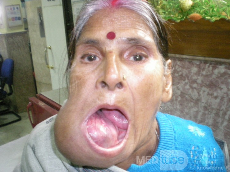 Large Maxillary Tumour