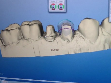 CEREC AC - Proposals Gone Wrong