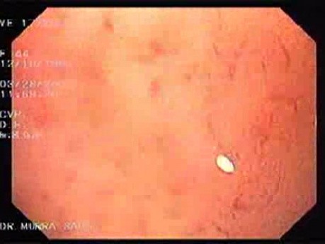 Magnifying Endoscopy