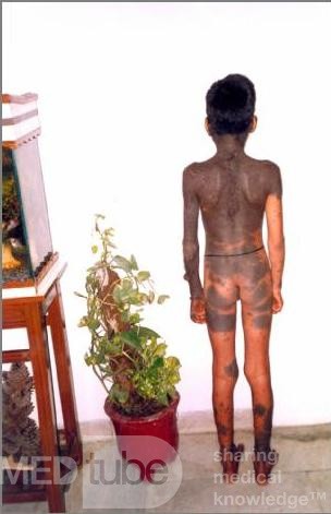 Hyperpigmentation
